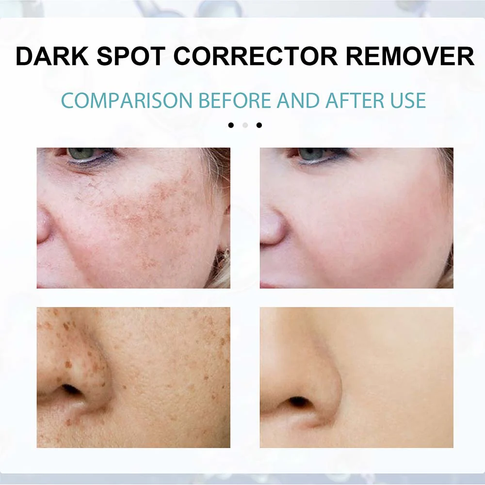 Anti-Dark Spot Skin Care Lightens Pigmentation Spots - Image 2