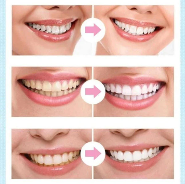 Dental Whitening Pen - Image 3