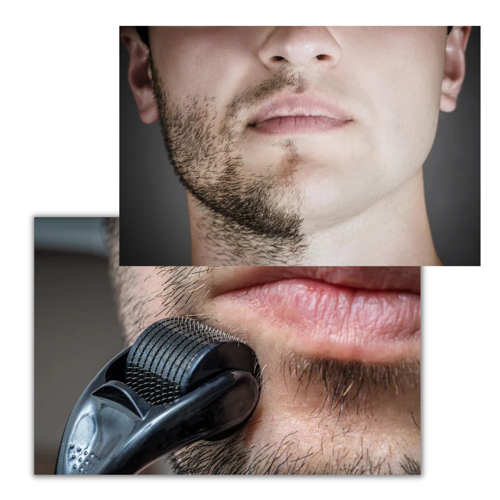 Dermal Roller For Hair And Beard Growth - Image 3