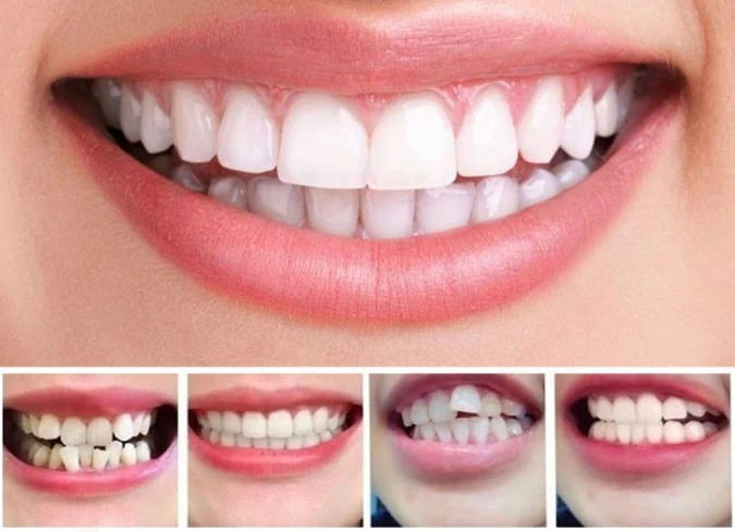 Invisible Dental Realignment Tray - Image 2