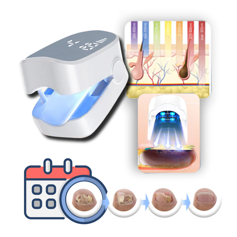 Laser Therapy, Pain-Free For Nail Fungus - Image 3