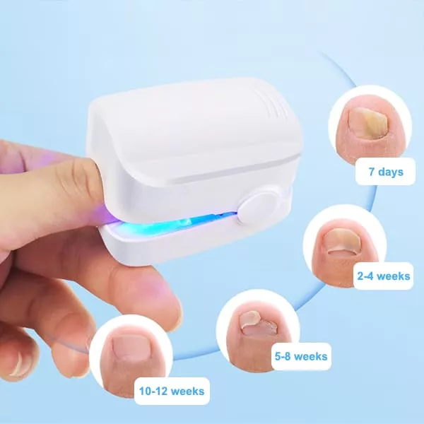 Nail Fungus Cleaning Laser Device - Image 3