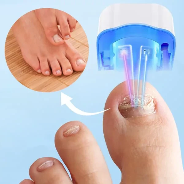 Nail Fungus Cleaning Laser Device - Image 4