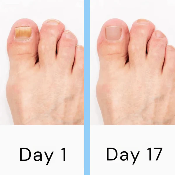 Nail Laser Fungus Device - Image 5