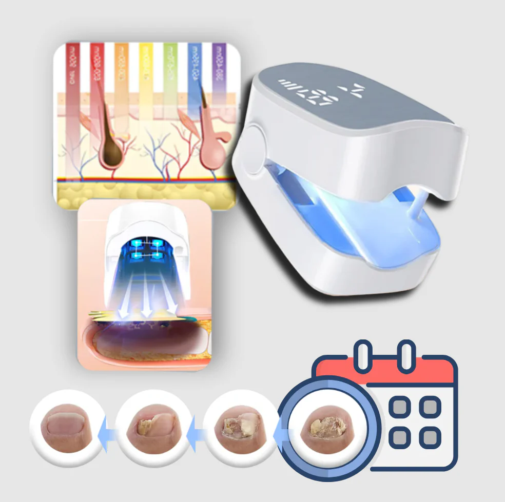 Painless Nail Fungus Laser - Image 3