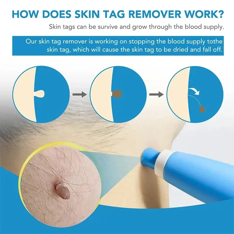 Skin Tag Removal Kit - Image 6