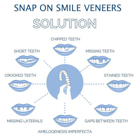 Smile Veneer (Upper & Lower Included) - Image 6