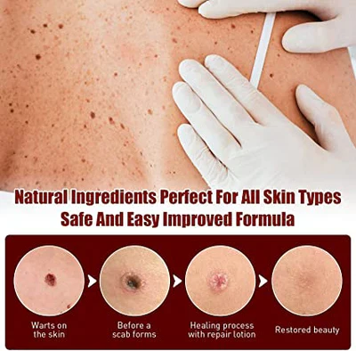 Tags & Moles Remover - Image 8