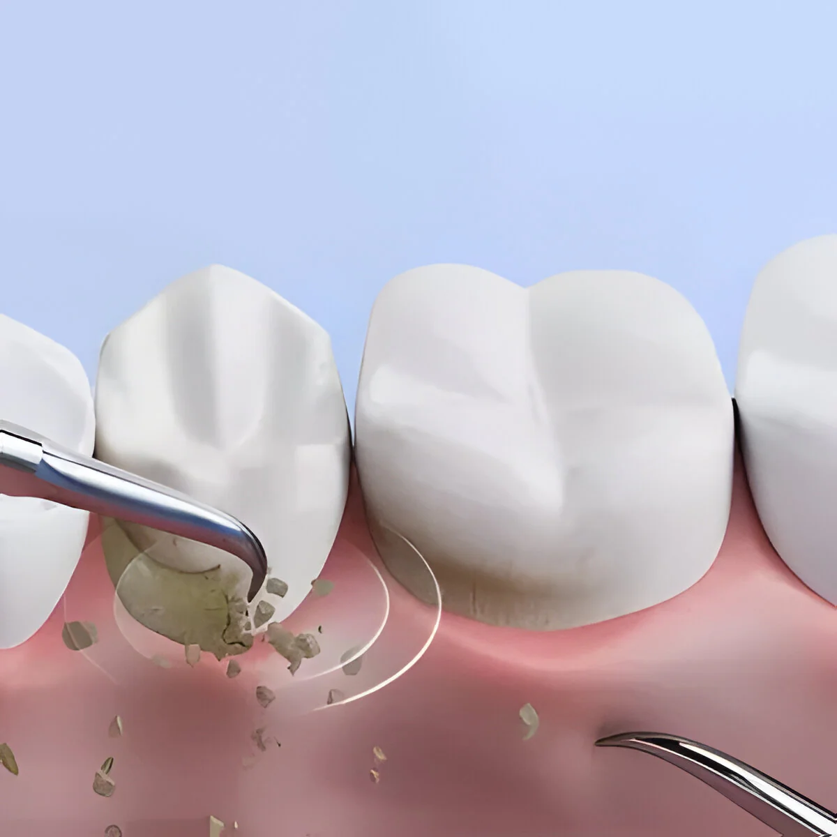 Ultrasonic scaler - Image 3