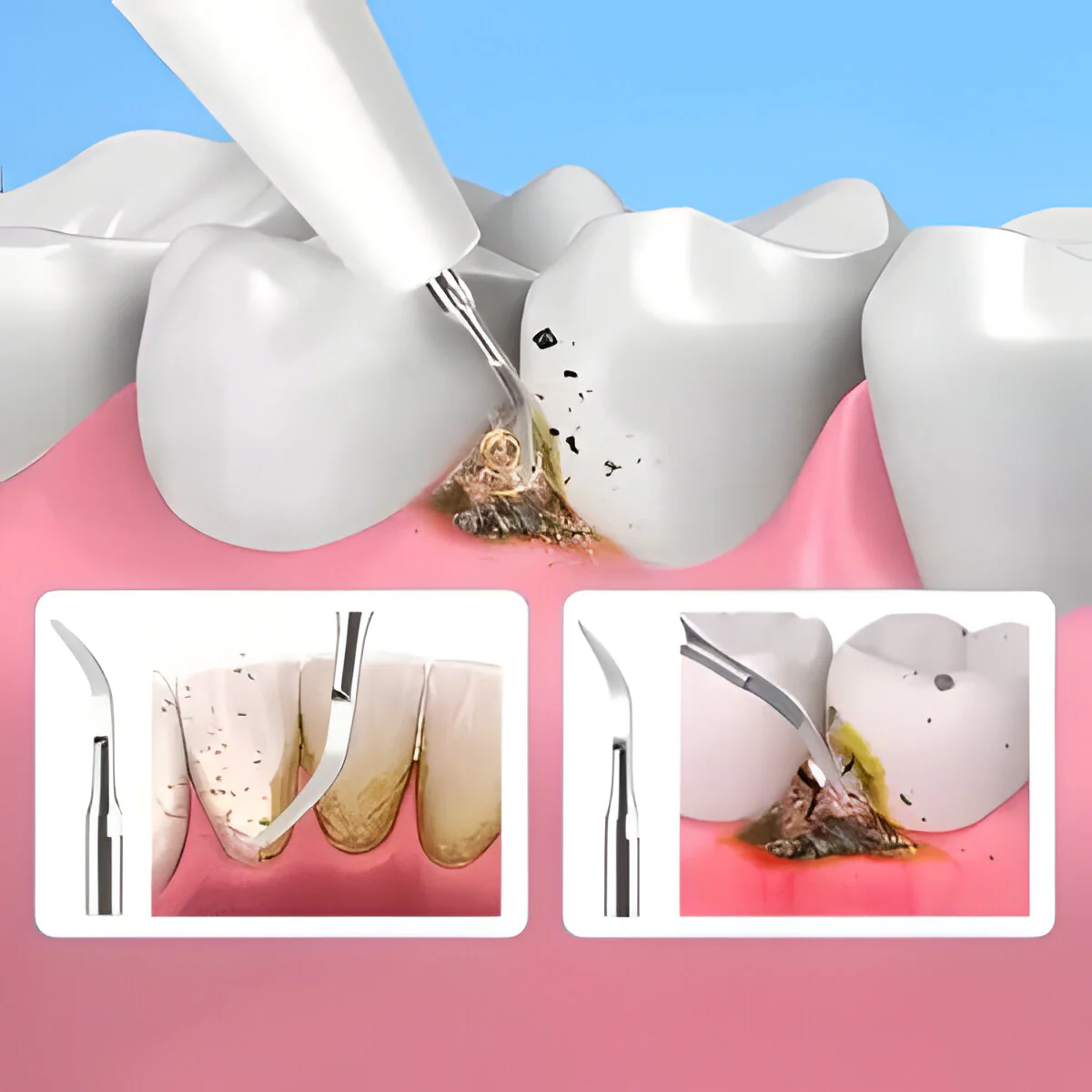 Ultrasonic scaler - Image 5