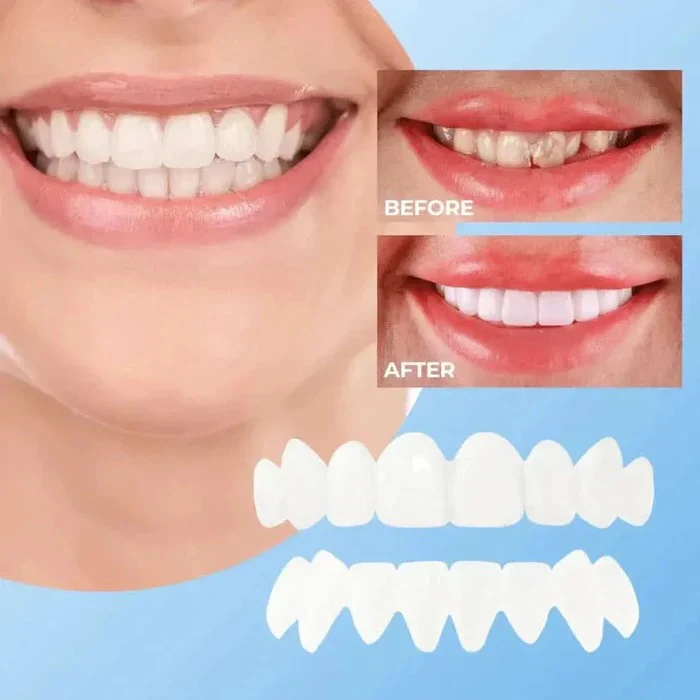 Veneers for Teeth with Natural White Finish - Image 4